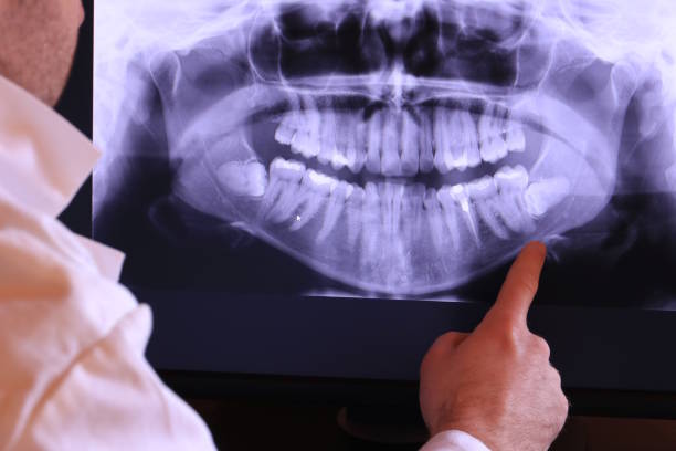 Best Emergency Wisdom Teeth Removal in Black Jack, MO